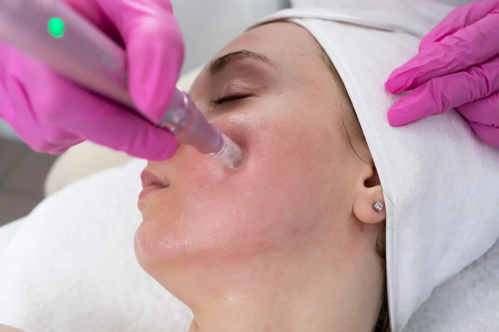 Microneedling pen treating the cheek